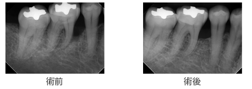 歯周病骨再生治療の例