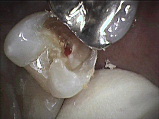 麻酔を効かせ、虫歯を取っていくと神経からの出血がみられます。