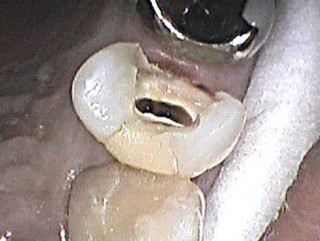 神経の治療は虫歯の部分をとるだけでなく、真ん中の部分を大きく削り、根っこの先端まで器具を入れます。最終的にはかぶせ物でかぶせて噛める様にします。