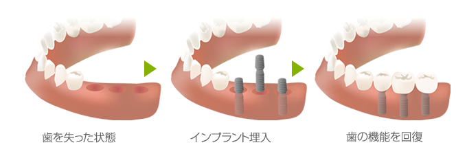 歯を失った部分の顎の骨にチタン製の人工歯根である「インプラント」を埋め込んで、人工歯を固定する治療です。 入れ歯やブリッジでは得られない、自分の歯に近い機能や外観を得ることができます。 